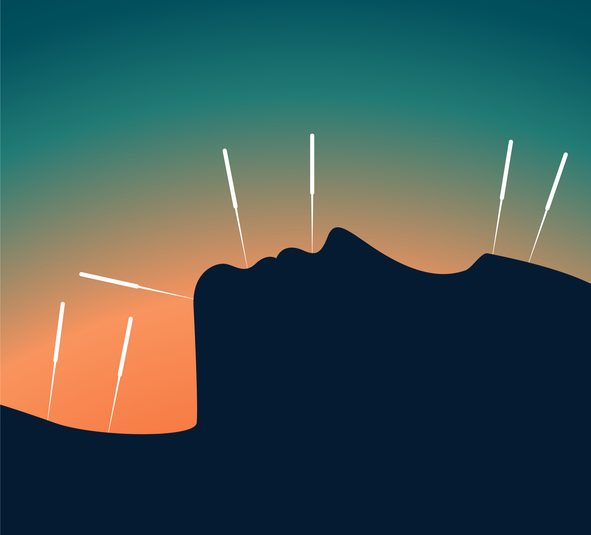 akupunktura, benefiti